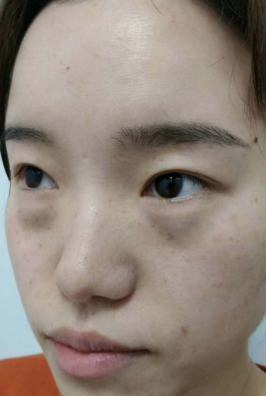 去眼袋手术