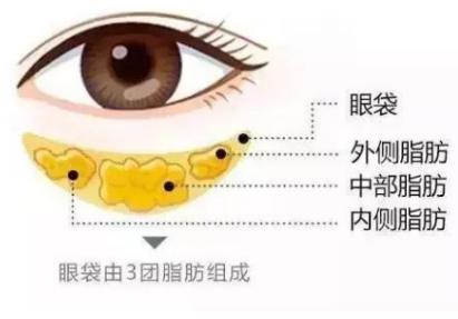 去眼袋手术