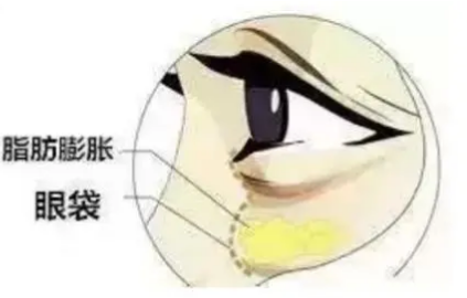 去眼袋手术