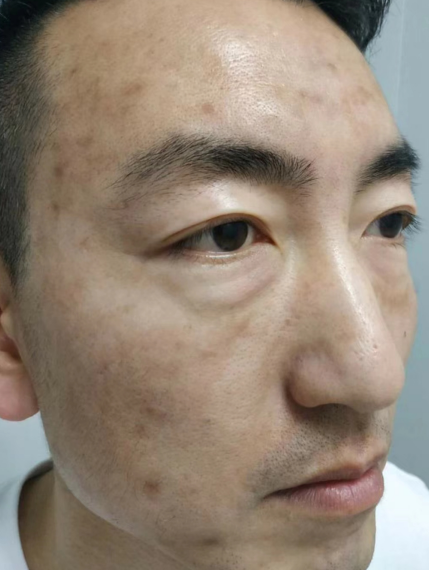 去眼袋手术
