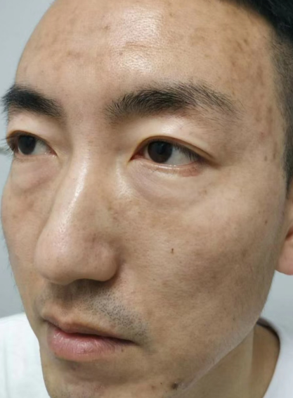 去眼袋手术
