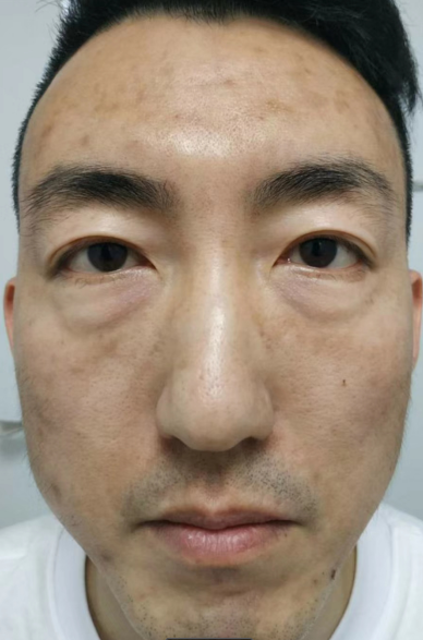 去眼袋手术