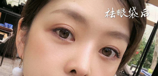 去眼袋手术