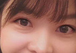 去眼袋手术