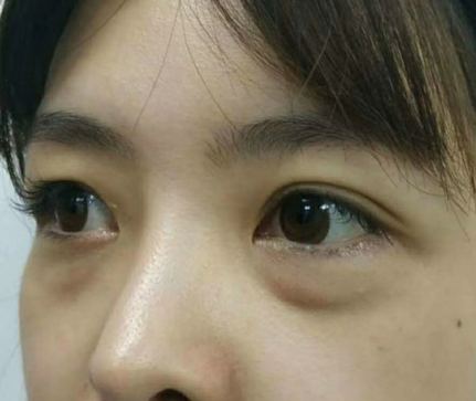 去眼袋手术