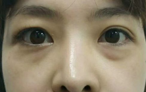 去眼袋手术