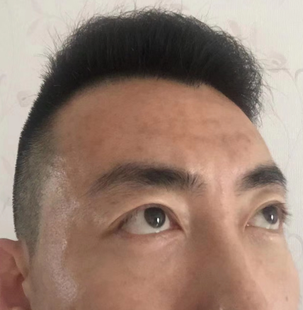 去眼袋手术