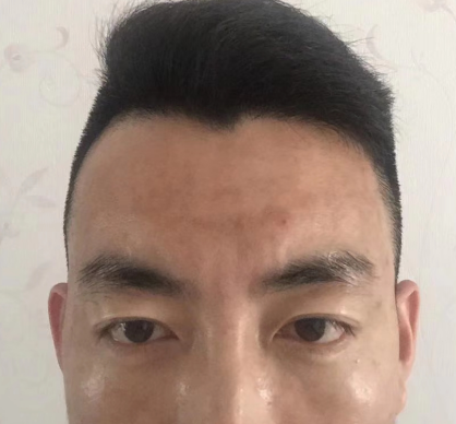 去眼袋手术