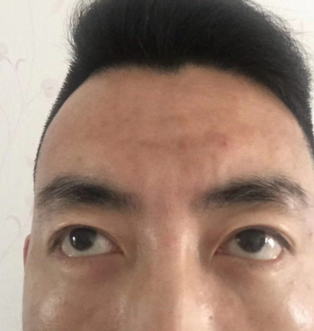 去眼袋手术