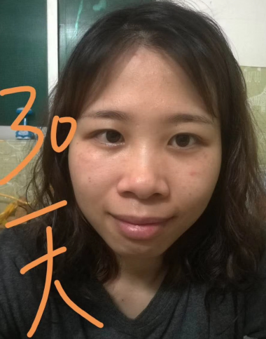 去眼袋手术