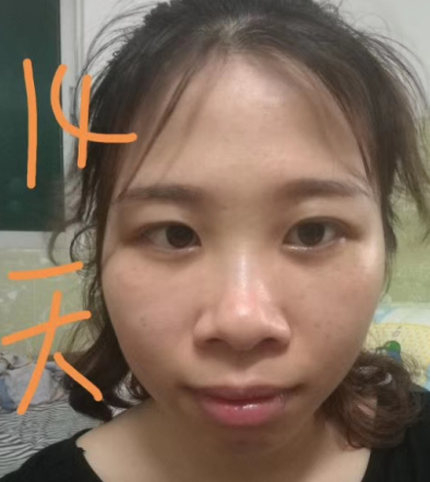 去眼袋手术