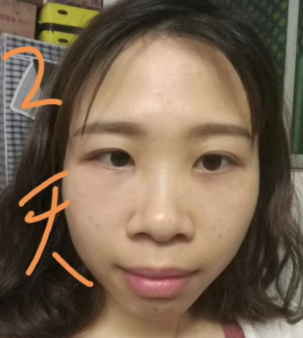 去眼袋手术