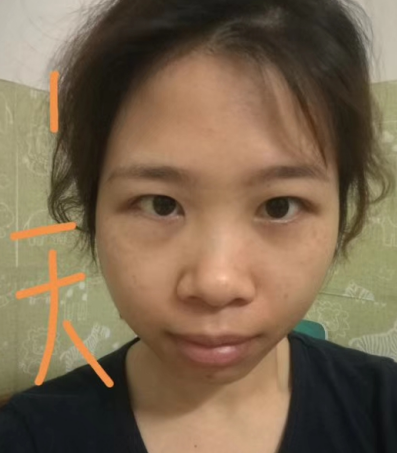去眼袋手术