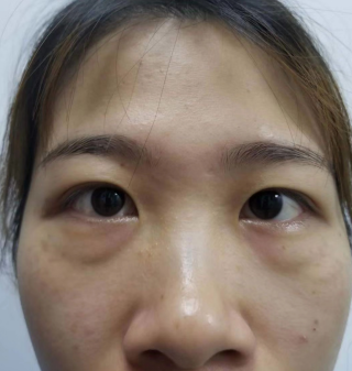 去眼袋手术