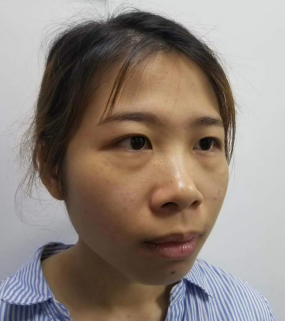 去眼袋手术
