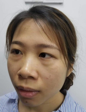 去眼袋手术