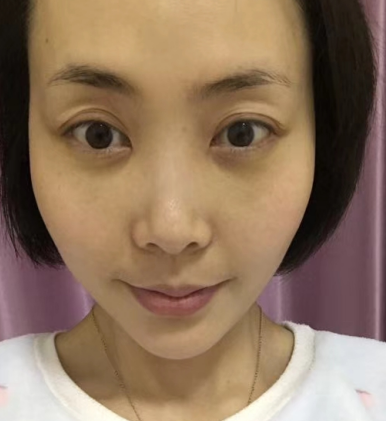 去眼袋手术