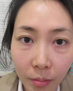 去眼袋手术