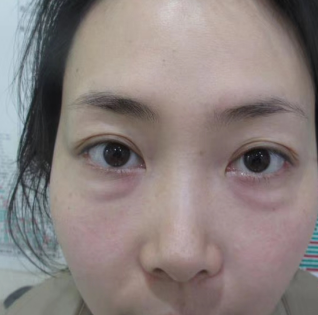去眼袋手术