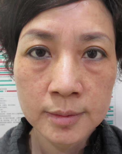 去眼袋手术
