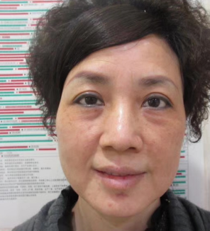去眼袋手术