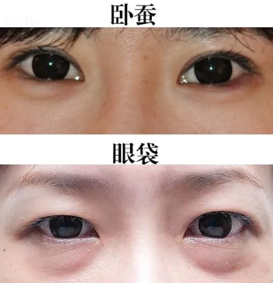 去眼袋手术