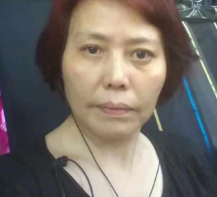 去眼袋手术