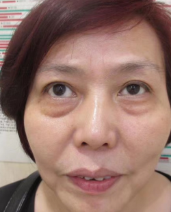去眼袋手术