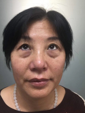 去眼袋手术