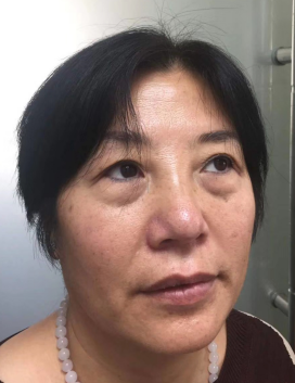 去眼袋手术