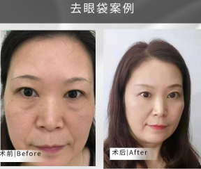 去眼袋手术