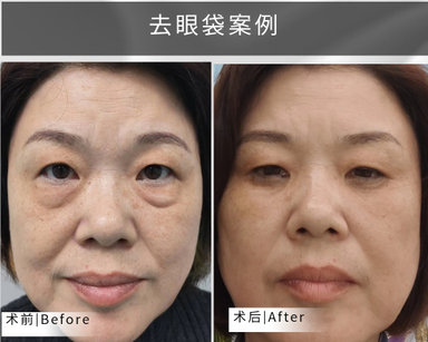 去眼袋手术