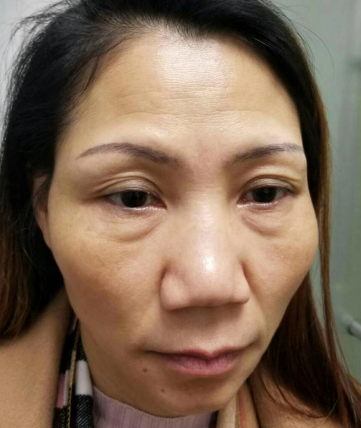 去眼袋手术