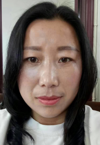 去眼袋手术