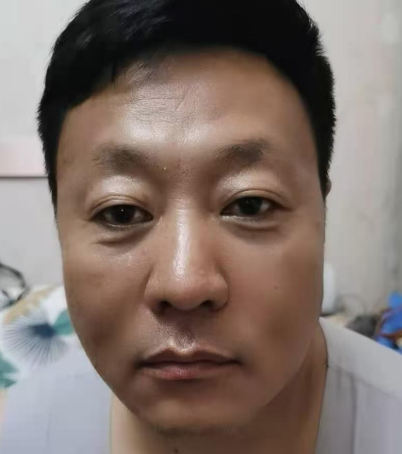 去眼袋手术