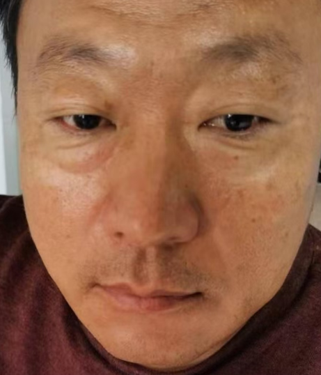 去眼袋手术