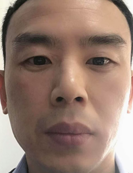 去眼袋手术