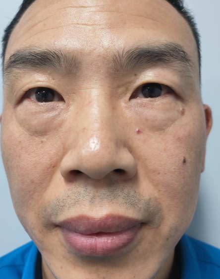 去眼袋手术