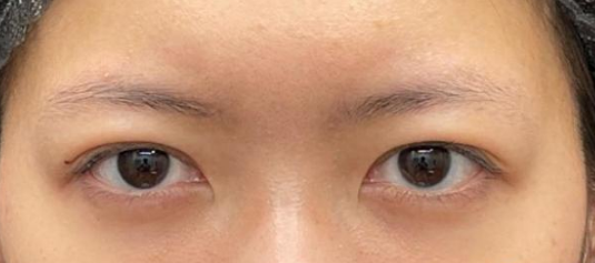 眼袋