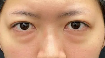 眼袋