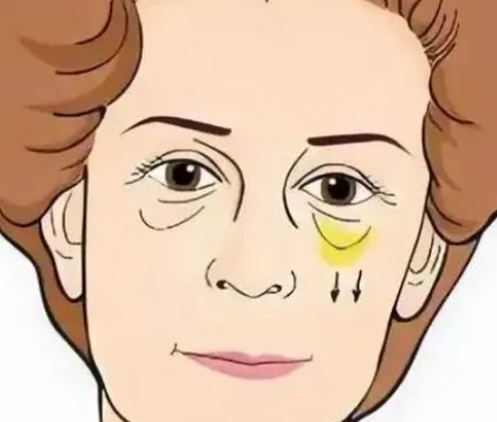 眼袋
