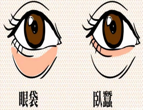 去眼袋手术