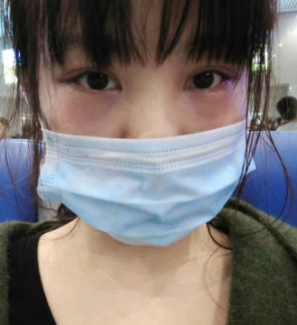 去眼袋手术