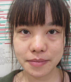 去眼袋手术