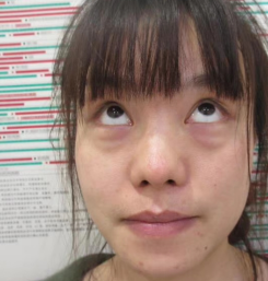 去眼袋手术