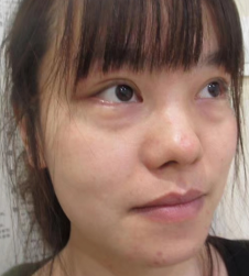 去眼袋手术