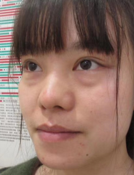 去眼袋手术