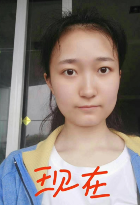 去眼袋手术