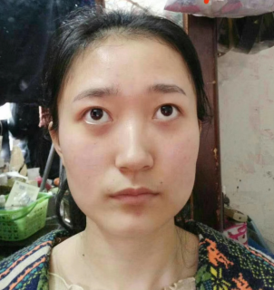 去眼袋手术