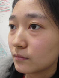 去眼袋手术